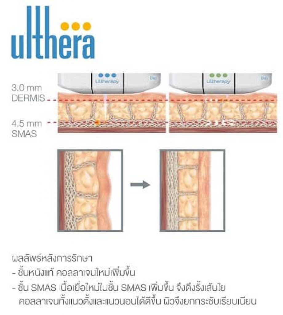 ulthera ดี ไหม รีวิว