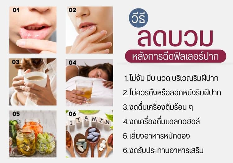 หลังฉีดฟิลเลอร์ปาก บวมกี่วัน