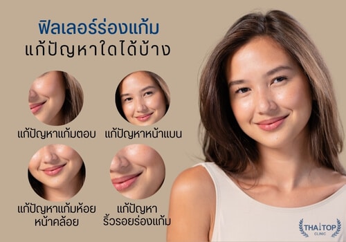 ฟิลเลอร์ร่องแก้ม restylane